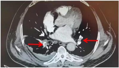 Early diagnosis of occult pulmonary embolism secondary to lower limb fractures: summary of 18 cases